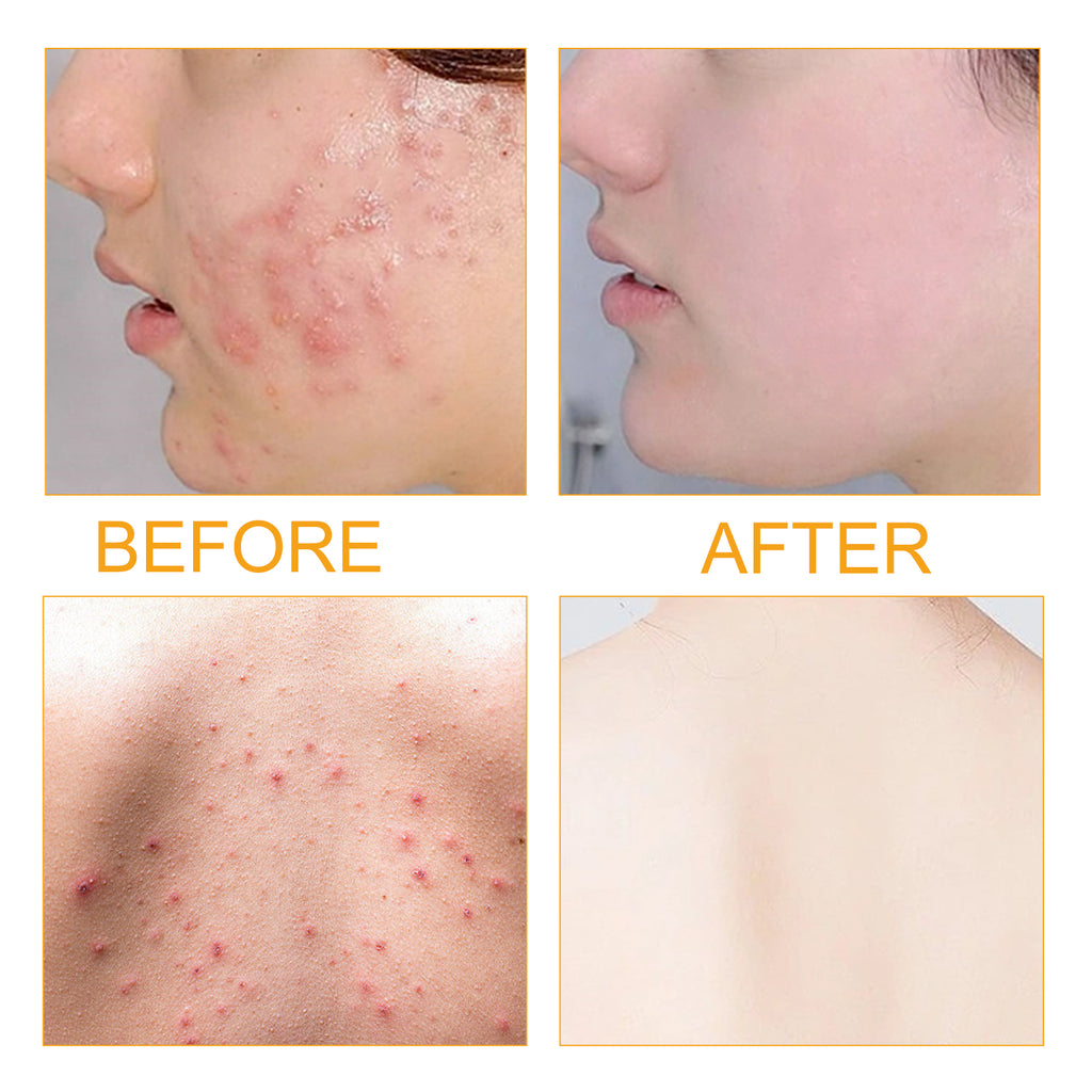 Jayusing Anti-Acne And Anti-Acne Serum, Reduce Acne And Acne Mark Moisturizing Skin Repair Serum